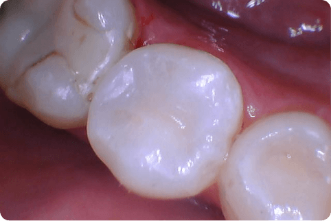 Smile with tooth colored fillings