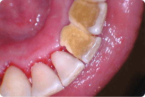 Smile after decay and discoloration is repaired