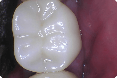 Healthy white tooth enamel after dental restoration