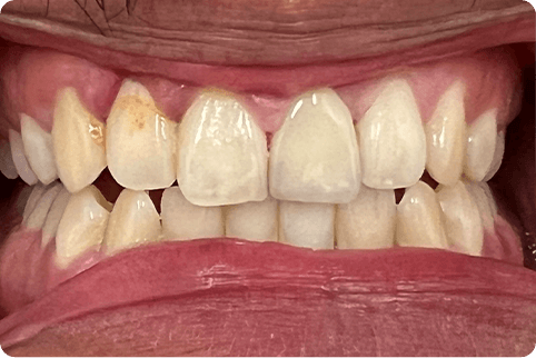 Smile after top tooth is repaired