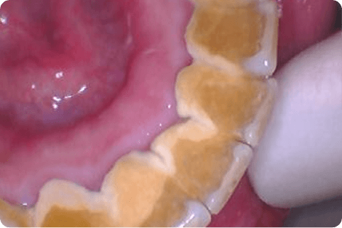 Smile with significant decay and discoloration inside of teeth