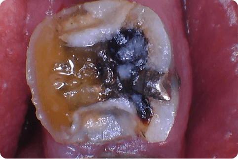 Dark damaged tooth before dental resotration