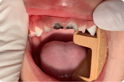 Smile with severe decay and damage on upper teeth