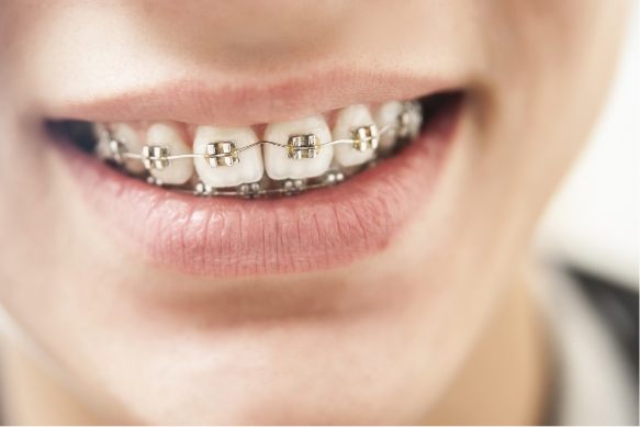 Closeup of smile with traditional braces